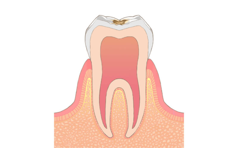 エナメル質に達するむし歯