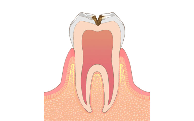 象牙質に達するむし歯