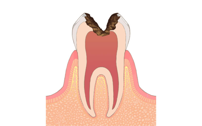神経に達するむし歯
