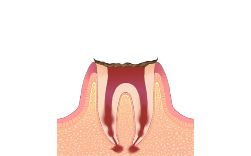 歯の根だけ残った末期のむし歯